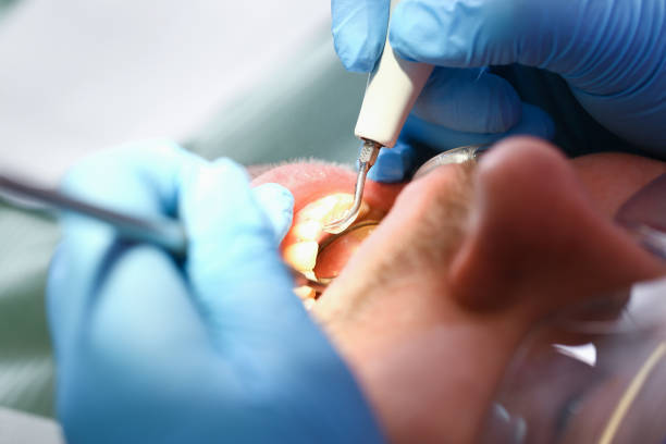 Best Broken or Cracked Tooth Emergency Dentist in Dash Point, WA